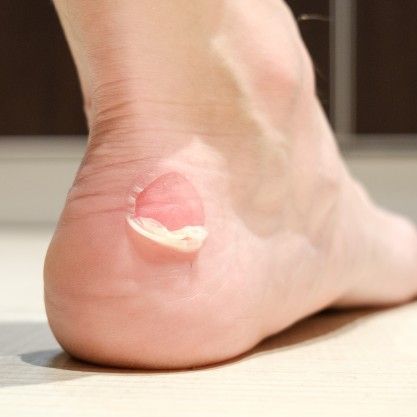 Drama Tact opslaan Blaren op je voeten behandelen | Feet in Motion